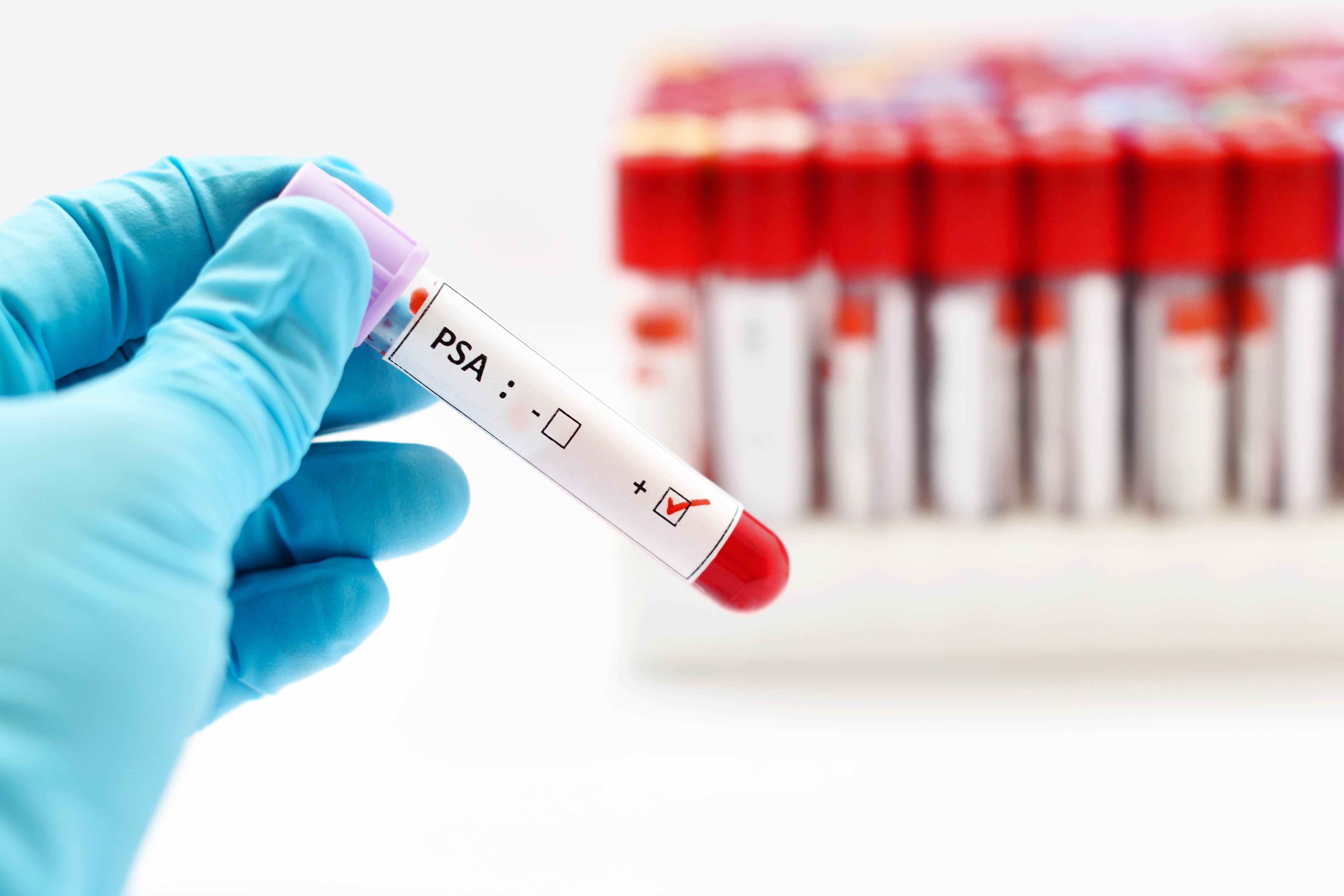 Blood sample with PSA (Prostate-specific antigen) positive