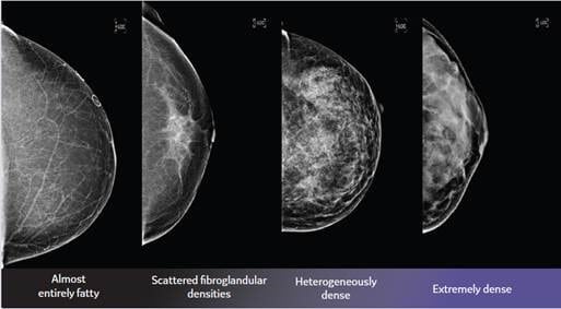 Do You Know Your Breast Density Ge Healthcare United States