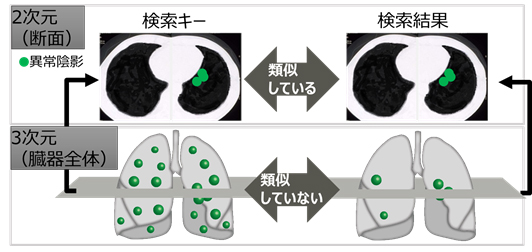 これからのct画像はaiで診断支援 類似症例の正解率は85 診断時間は6分の1 Fujitsu Journal 富士通ジャーナル