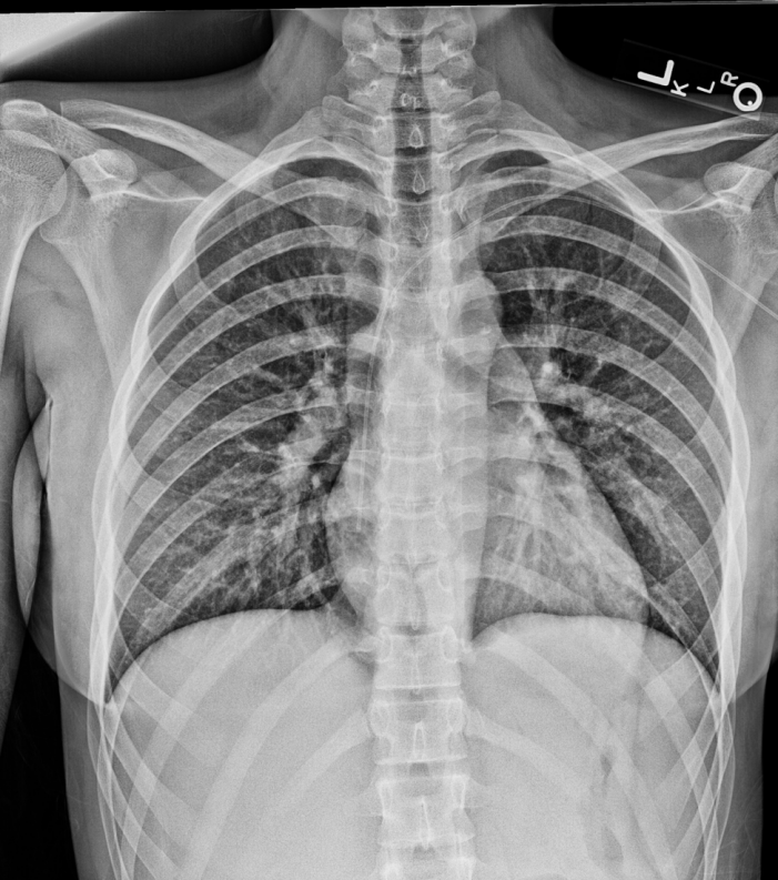 Ai Embedded X Ray System Could Help Speed Up Detection Of A Collapsed Lung Ge Healthcare United States