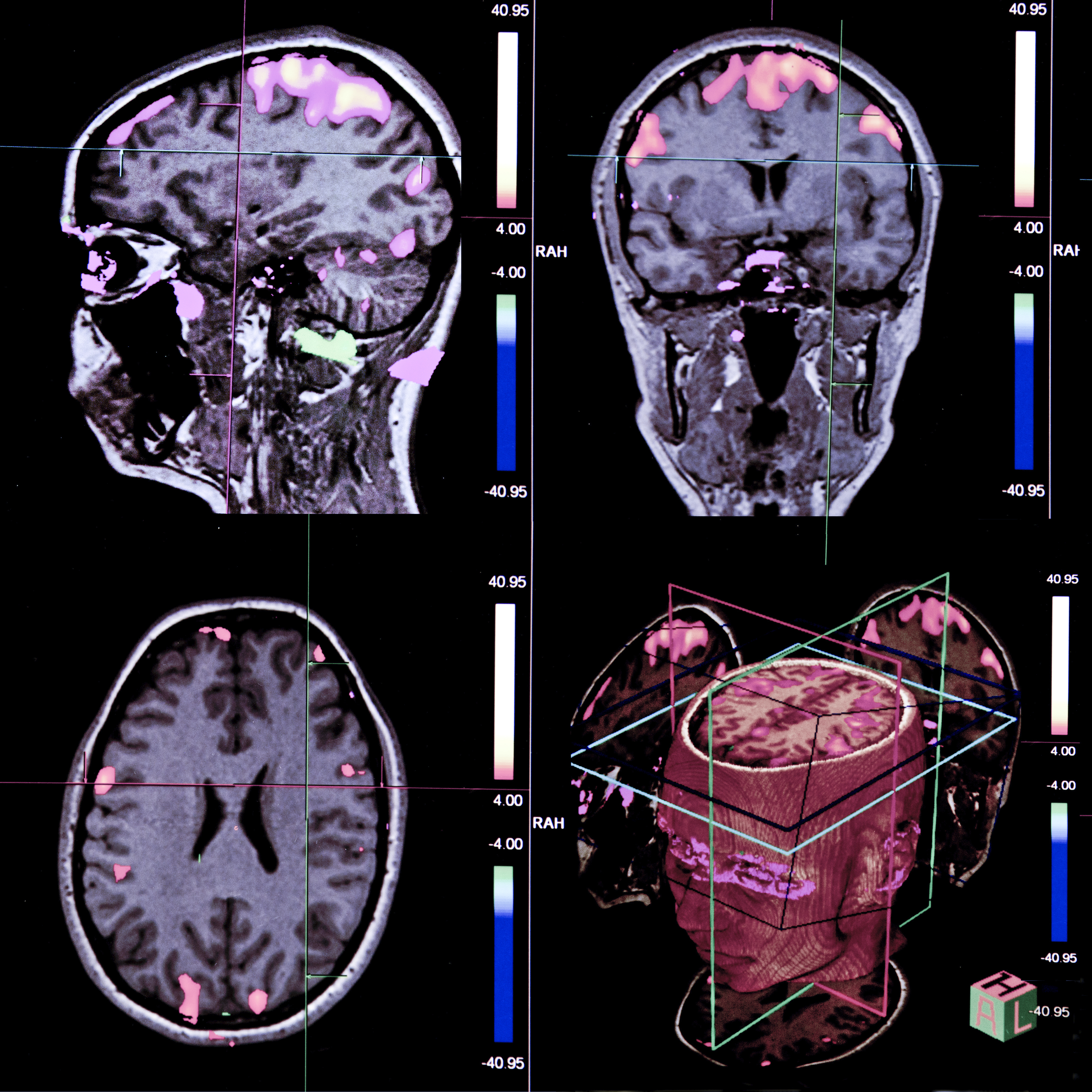 brain MRI with 3D rendering