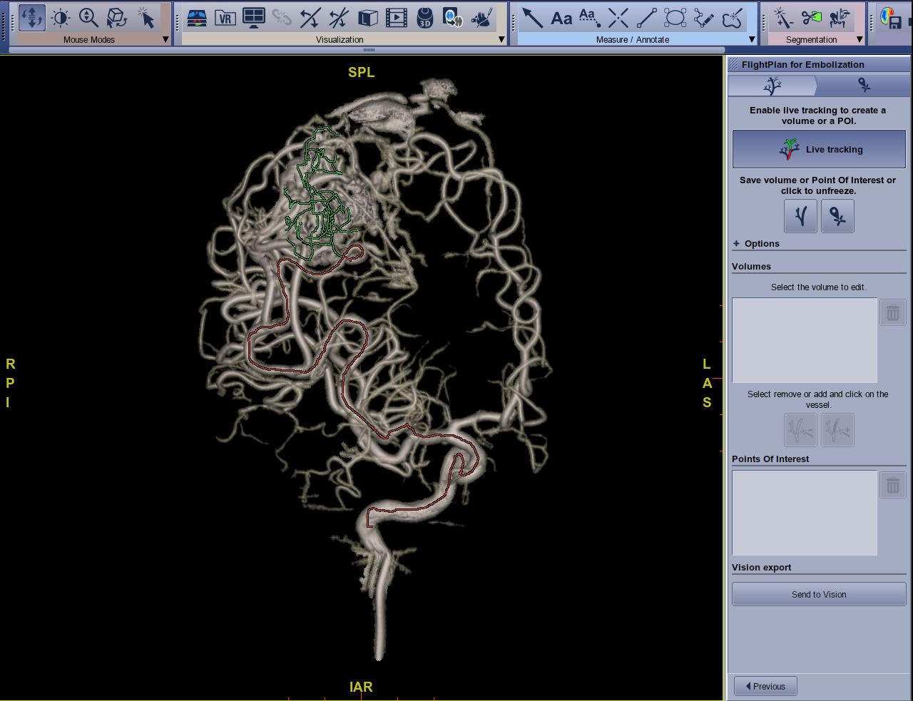 How Complex Embolization Procedures Can Be Virtually Planned To Ensure Confidence And Efficiency 7584